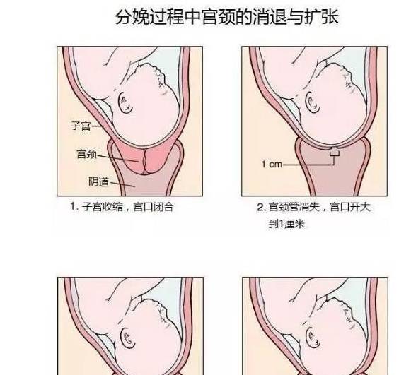 顺产全部过程宫颈图片
