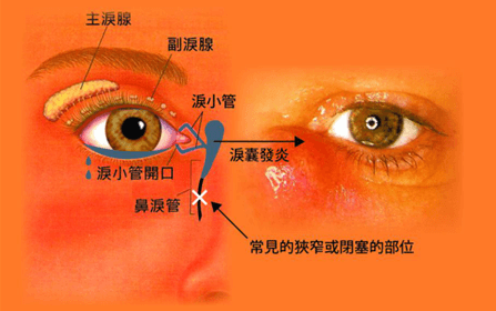 眼睛总流泪是怎么回事？