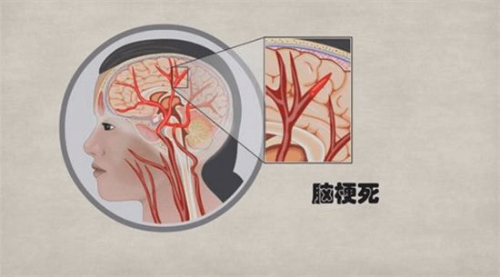 爱打麻将的人容易脑出血吗