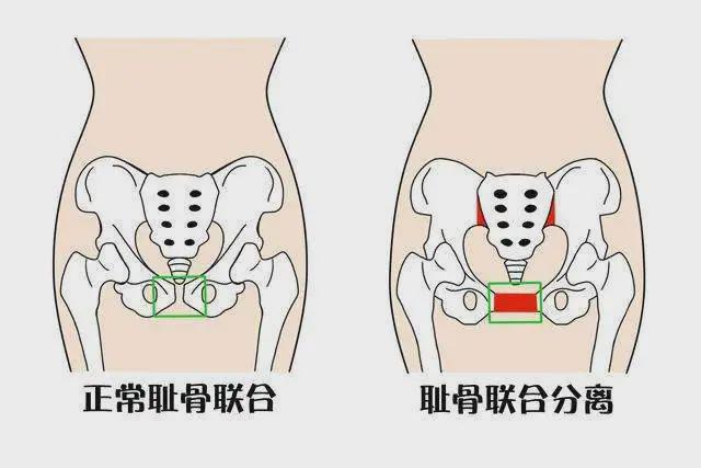 耻骨联合位置图体表图片